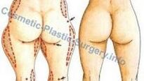 Liposukce - invazivní nebo neinvazivní Liposukce - invazivní nebo neinvazivní